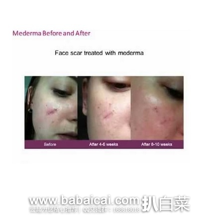 Mederma 美德 Advanced Scar Gel 加强型祛疤凝胶 20g 原价.84,现.81-1.5=.31,直邮无税,到手¥95